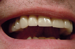 牙齒沒刷「對」，竟會提高腸癌和「阿茲海默症」風險，牙齦常出血者更要看！