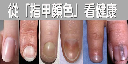 指甲蒼白是「缺血」還是「肝炎」？關於指甲顏色的「6組健康密碼」，你都釐清了嗎？｜每日健康Health