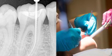 牙醫師極力打破的「根管治療」四迷思！公開「中、西醫」聯手教導的「護牙大法」！｜每日健康Health