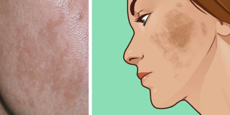 你也有令人討厭的「黃褐斑」嗎？6個天然方法改善皮膚變色，戰勝「媽媽臉」！