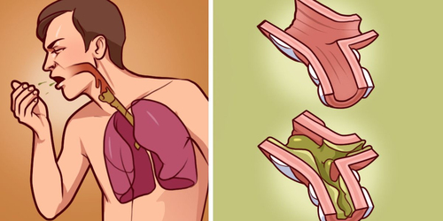 你常咳痰嗎？秒懂7種「痰的顏色」對應疾病，「呼吸道感染」跟「肺水腫」只在一線之間｜每日健康