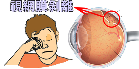揉眼睛小心揉出「視網膜剝離」！兩步驟輕鬆泡出「補腎健眼」的「枸杞茶」｜每日健康Health