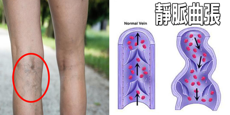 稍微久站「靜脈曲張」馬上現形？簡易、天然的按摩療法，消除血管腫脹恢復美腿。
