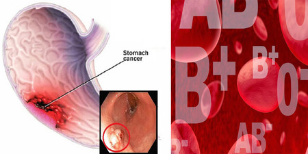 血型也能決定「胃癌」風險！「三大癌前徵兆」別讓「胃潰瘍」與胃癌只有一線之隔｜每日健康Health