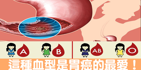 什麼！「血型」竟然決定「胃癌」機率？這種血型再加上「口臭」風險爆表｜每日健康