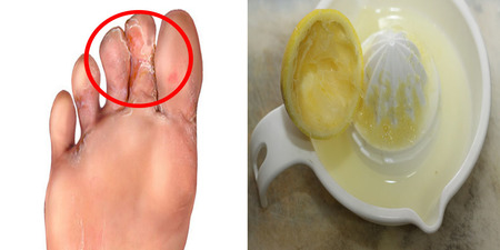食醋、檸檬汁能改善「腳臭」？遠離香港腳只要活用「殺菌二式」，迅速解救受「黴菌」侵襲的雙足｜每日健康 Health