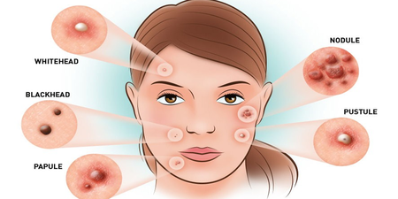 八大保養捷徑—–解決你的肌膚疑慮「代謝角質、擦拭抗生素」跟「粉刺」說拜拜！
