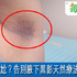 「腋下」黑黑舉手好丟臉!醫:網路偏方多,千萬別塗這一種免得皮膚灼傷潰爛!