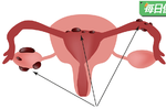 婦女病：子宮內膜異位名列前茅，五大症狀一秒看懂