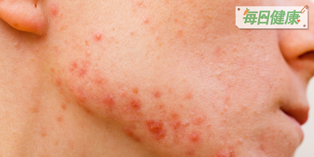 臉上「紅斑」不是過敏，而是「螨蟲」寄生正在搾取皮膚油脂！一秒看懂「除蟲洗臉法」｜每日健康 Health