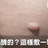 皮膚上長出粉瘤醜醜的?7種無痛去瘤法,這樣做快速找回平滑肌膚|每日健康 Health