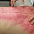 刮完痧就沒事了?錯錯錯!中醫師叮嚀:5件事沒做等於沒刮、超傷身|每日健康 Health