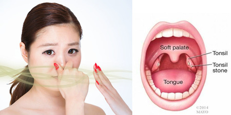 口腔的「味道」能看出您身體出什麼問題，口腔常常有「異味」？有可能是因為患有「扁桃腺結石」！