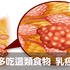 乳癌竟和細菌有關!研究證實:多吃這類食物有效抑制壞菌,雙峰健康沒煩惱|每日健康 Health