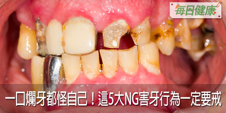 40年老牙醫的告白！台灣牙周病率世界第一都要怪自己，不戒5大NG害牙行為，難怪滿口發黃有牙垢｜每日健康 Health