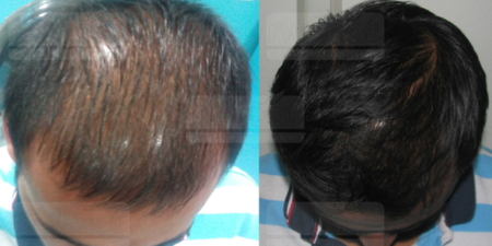 搶救禿頭大作戰！3種天然原料​治療「脫髮」，強健頭皮，便宜又有效。