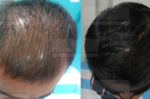 搶救禿頭大作戰！3種天然原料​治療「脫髮」，強健頭皮，便宜又有效。