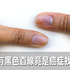 指甲上有黑色直線只是缺鈣、甲下出血? 她去醫院一檢查嚇壞了,東方人更要注意!|每日健康 Health