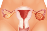卵巢癌5年存活率不到1成！癌細胞原來都長在女性這部位，肚子痛、骨盆痠四徵兆馬上就醫｜每日健康Health