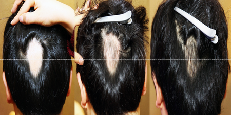 頭上不但「禿一塊」，髮量還愈來愈少？簡單一招敷在頭皮，毛囊全部活過來了。