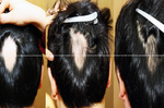 頭上不但「禿一塊」，髮量還愈來愈少？簡單一招敷在頭皮，毛囊全部活過來了。