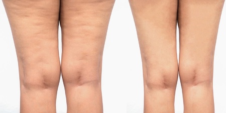 橘皮組織退散！藥師自製「纖體凝膠」還妳修長緊緻的美腿｜每日健康 Health