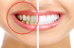刷牙發現牙齦出血？「牙齦炎」恐惡化成「牙周病」！8種護牙密技，讓你重拾自信笑容。