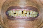 牙齒不好是「小弟弟」崩潰預兆？研究：53%勃起障礙有關｜每日健康 Health