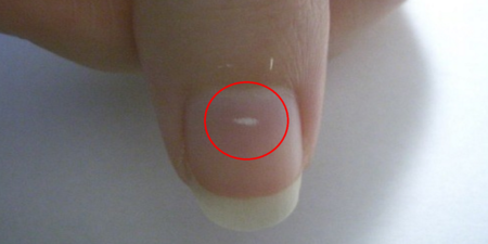你的指甲上也有「小白點」嗎？指甲出現「兩種情況」應就醫，當心是潛在疾病的徵兆。