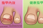 「指甲倒插」痛得讓人難以言喻，嚴重可能引起「甲溝炎」！必學的正確護甲術！