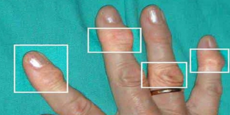 「關節炎」嚴重可導致手指變形，不可輕忽！7種自然療法有效緩解，疼痛、變形遠離你。