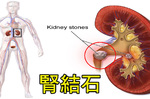 台灣「腎結石」盛行，9種蔬菜「這樣吃」把腎臟清乾淨，改善結石，從此不當石頭一族。