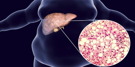 放任不管恐變肝癌　常食兩款「粥療」有效消滅肝臟脂肪｜每日健康 Health