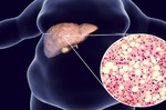 放任不管恐變肝癌　常食兩款「粥療」有效消滅肝臟脂肪｜每日健康 Health