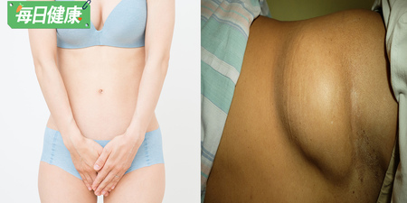 女子會陰凸起「脂肪瘤」嫌疑大！　醫師曝：長在「這部位」約４成自爆GG
