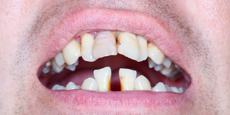 牙周病早期無徵兆，居家護理10招要知道：掌握「45°」才算正確潔牙｜每日健康 Health