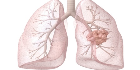 從手指、乳房也能看出「肺癌」跡象？20%患者不吸菸　8徵兆揪出癌蹤