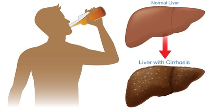 肝臟每天能承受多少酒？喝超過這個量100%罹患肝病｜每日健康 Health