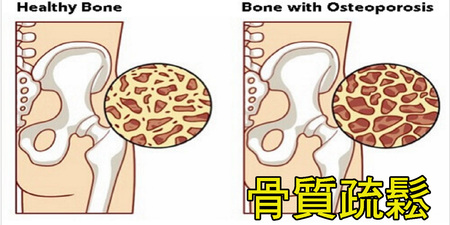 預防「骨質疏鬆」，絕對不是靠喝牛奶！「8種健骨食物」這樣吃，80歲依然骨頭硬朗。