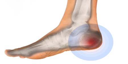 「腳跟痛」的元兇是發炎！推薦5招助緩解｜每日健康 Health