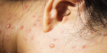 水痘就是皰疹嗎？會如何傳染？初期發病徵兆有哪些？家醫科主任一次說分明