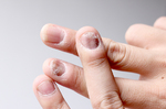 錢政弘：手指揪病徵，4大症狀當心冷凝球蛋白血症