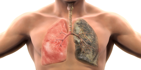 「我不抽菸，為什麼會得肺癌？」　內科醫師揭六原因罹癌率多50倍