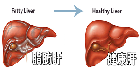 台灣3分之1人口有「脂肪肝」問題，「逆轉脂肪肝」的7大絕招，救肝降脂不能再拖！