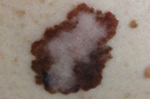 許多人防曬都忽略這部位　皮膚科博士：罹致命皮膚癌率恐爆增2倍！