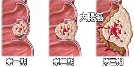 「大腸癌」早期症狀不明顯，若體重變輕、食慾不振或「慢性疲勞」，小心是息肉癌變的癥兆。