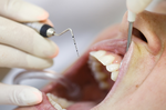 牙齦出血、變色？醫師揭「牙周病」十大併發症：中風、罹癌機率多3倍