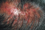 頭皮屑變多恐是「頭癬」在作怪！醫師建議5件事少做避免頭髮掉光光