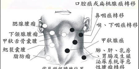 頸部有腫塊就是癌症？耳鼻喉科醫師指出5個「生長位置」最危險