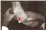腳踝扭傷怎麼辦？緊急治療「P-R-I-C-E步驟」一定要學起來！